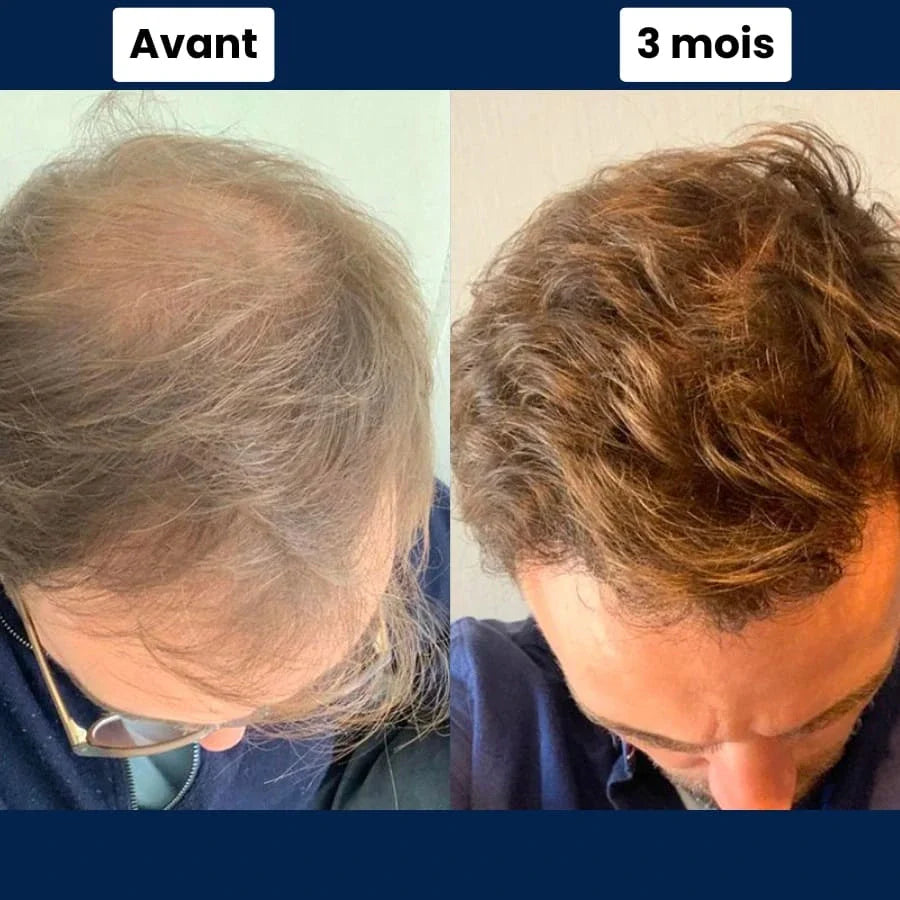 Collagix Micro Infusion - Régénération Capillaire