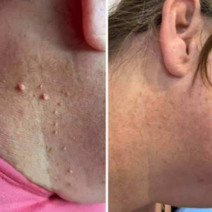 Alcura - Set complett